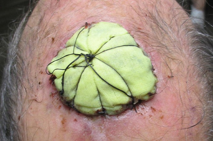 Skin Grafts | Springer Nature Link