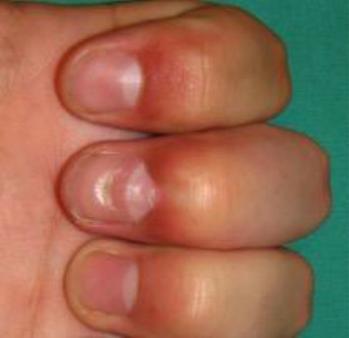 Mallet Finger Injuries | SpringerLink