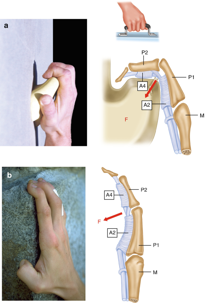 Climber's Pulley Injuries | SpringerLink