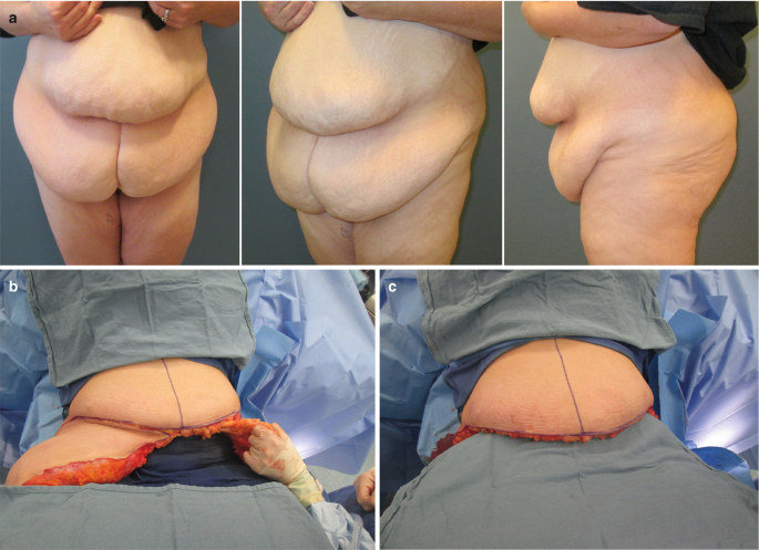 Abdomen: Panniculectomy and Abdominoplasty