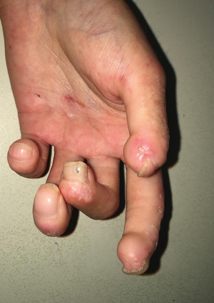 Scleroderma-Symptoms-Diagnosis-Treatment-Homeopathic-Conventiona-Allopathic-Dr-Qaisar-Ahmed-Risalpur-KPK-Pakistan