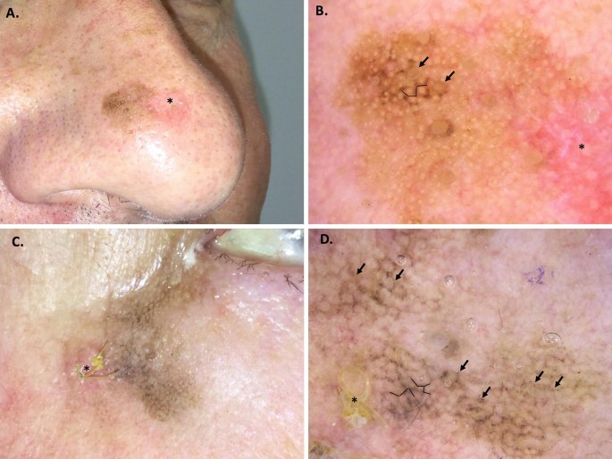 melanotic freckle of hutchinson Medical vocabulary: What does Hutchinson's mean Lentigo Maligna Melanoma | Springer