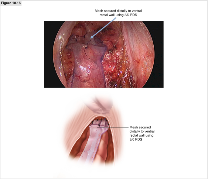 Laparoscopic Ventral Rectopexy for Rectal Prolapse | SpringerLink