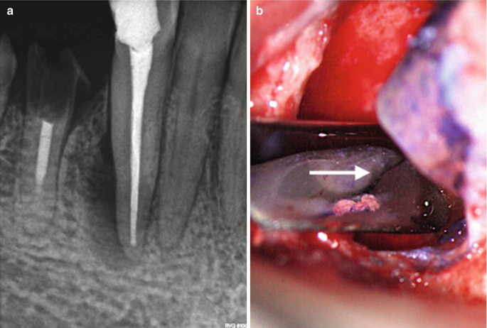 a Mandibular fistula indicated by an arrow in the apical region of dd