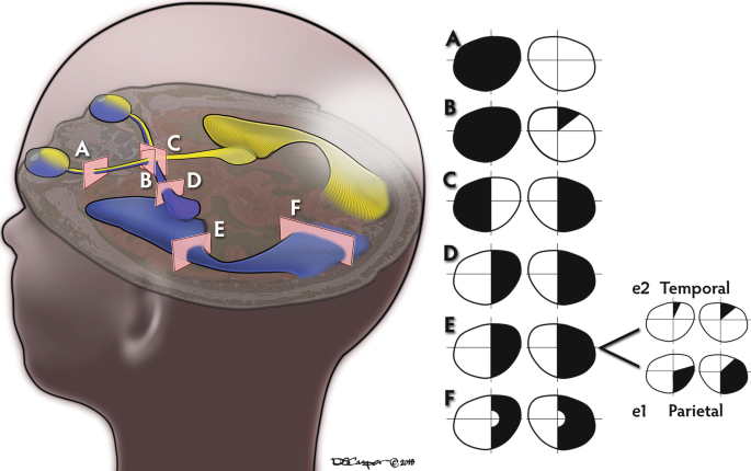 Optic Neuropathy | SpringerLink Optic Neuropathy | SpringerLink