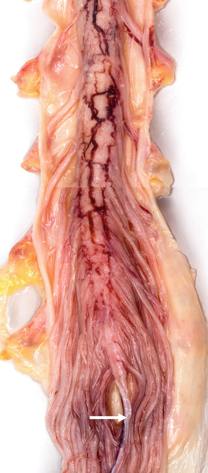 The Filum Terminale | SpringerLink