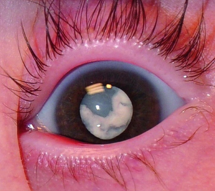 Differential Diagnosis of Leukocoria | SpringerLink