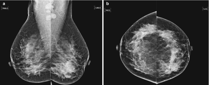 Breast Cancer, PDF, Mammography