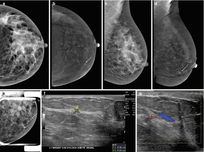 A 36-year-old patient with grade NOS II invasive breast cancer. A. The