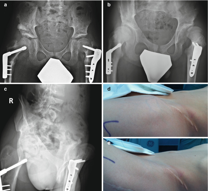 The Hip in Charcot-Marie-Tooth Disease | SpringerLink