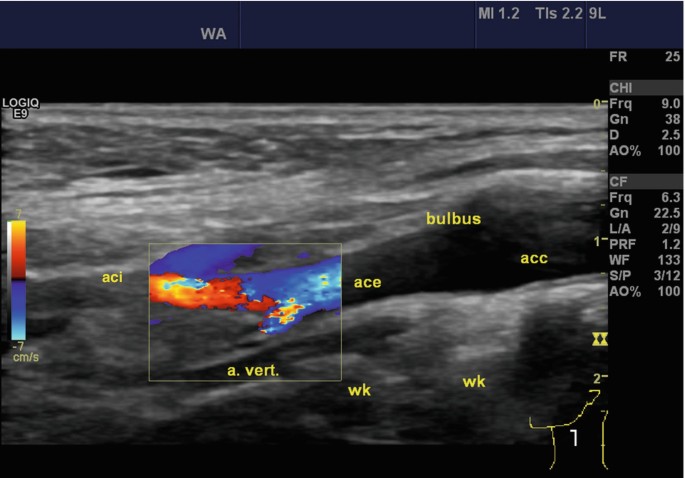 Sonography of the Large Neck Vessels and of Tumors with Suspected  Infiltration of the Large Neck Vessels | SpringerLink