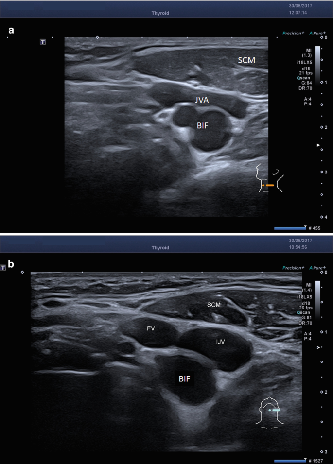 labeled thyroid ultrasound
