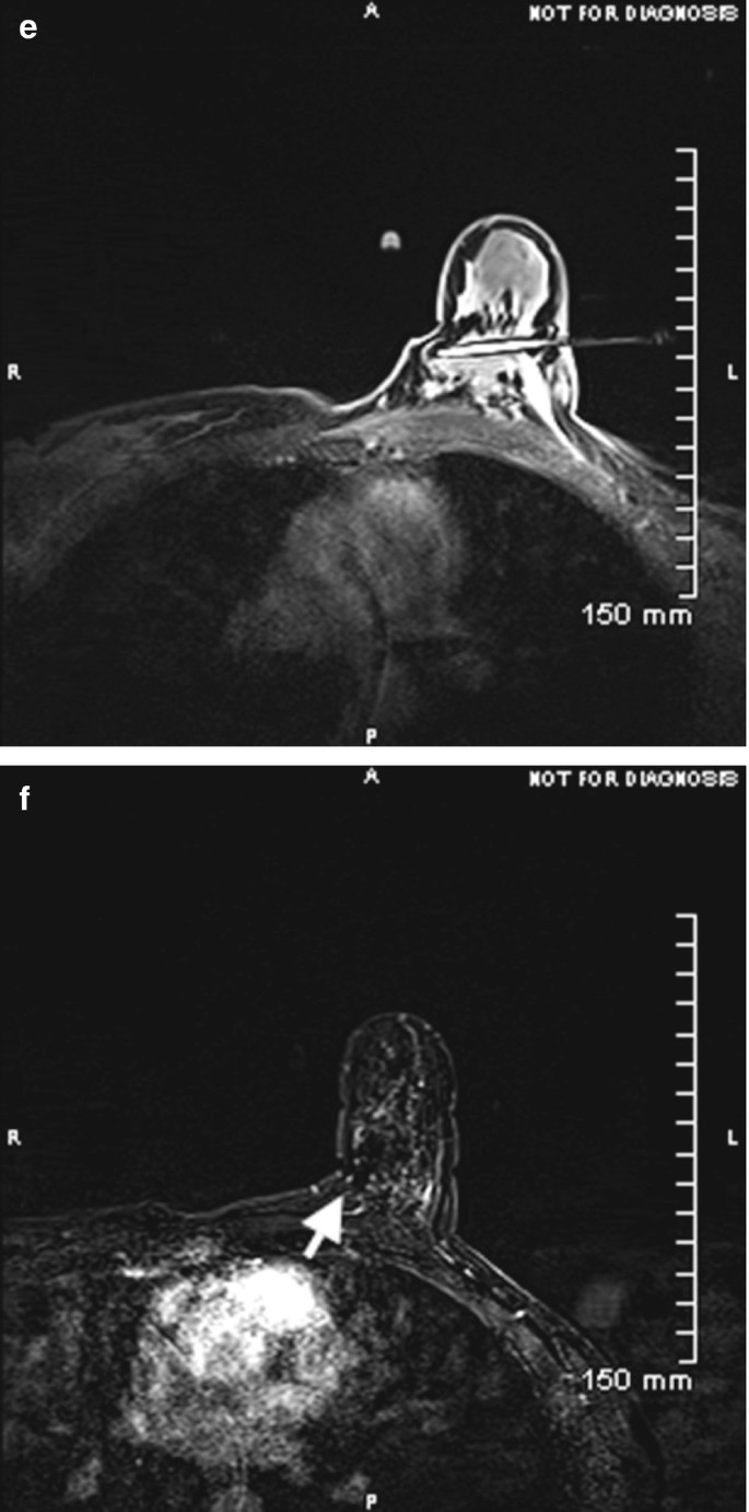 Tissue marker migration after MRI‐guided breast biopsy: Migration frequency  and associated factors - Funaro - 2020 - The Breast Journal - Wiley Online  Library