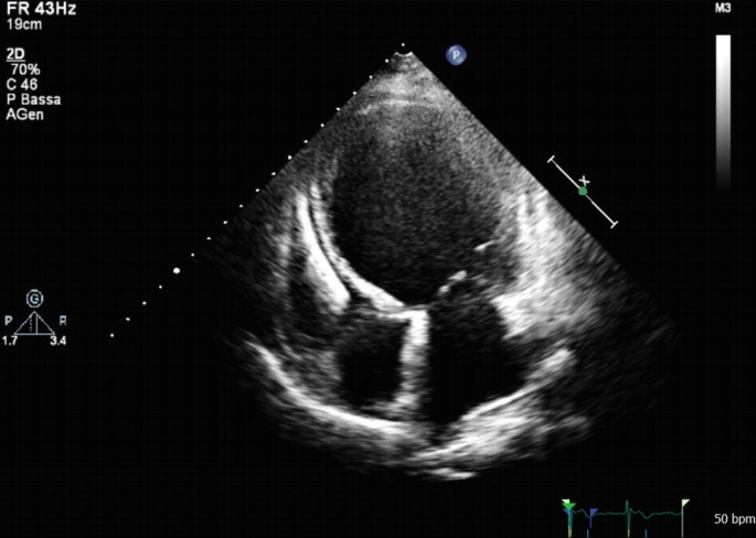 Case 43: Significant Spontaneous Echo Contrast In Left Ventricle (  DCM/Severe LV Dysfunction / LVEF : 15% in M- Mode / LVEF : 10% In Simpson's  Method., By Interesting cases in Echocardiography