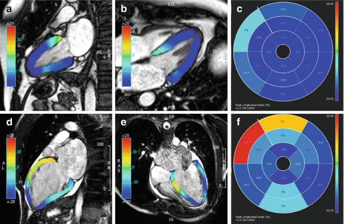 Reproducibility of 4D cardiac computed tomography feature tracking