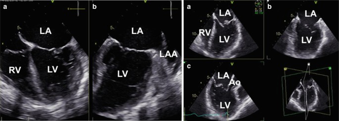 The Normal Mitral Valve | SpringerLink