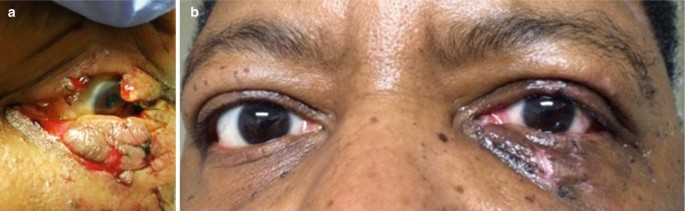 PDF] [Traumatic peri-ocular injuries: closing wounds using 2-octyl