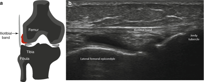 Friction Syndromes of the Knee