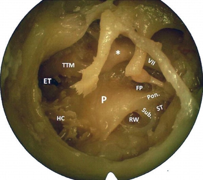 Middle Ear & Mastoid – Oto Surgery Atlas