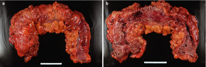 Crohn's Disease Features in Anastomotic Biopsies from Patients