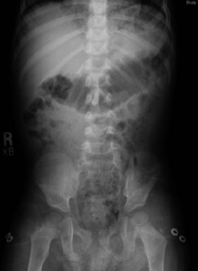 Case 52-1991 — An Eight-Year-Old Girl with Recurrent Abdominal Distention  after Surgical Correction of Hirschsprung's Disease