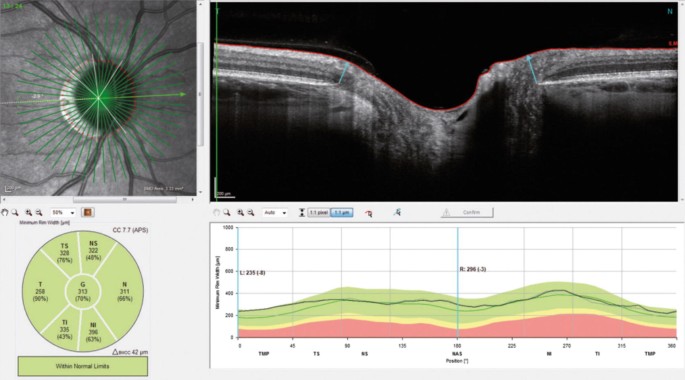 Contactless optical coherence tomography of the eyes of