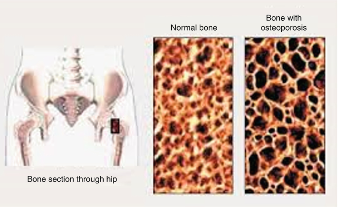 Osteoporosis and Fractures | SpringerLink Osteoporosis and Fractures | SpringerLink
