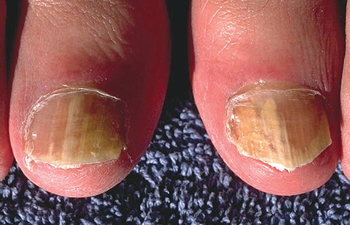 5 Most Common Nail Disorders & Diseases | White Rock Dermatology