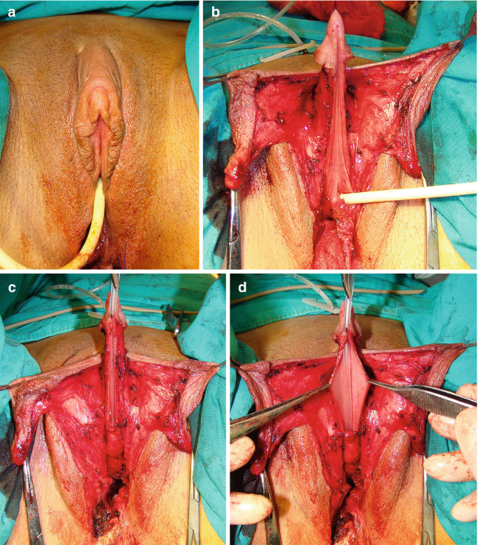 Surgical Anatomy: Metoidioplasty | SpringerLink