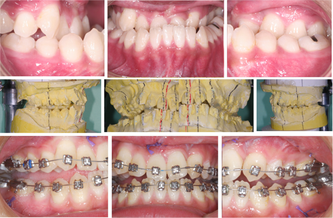 Placement of surgical hooks, completion of presurgical orthodontics.