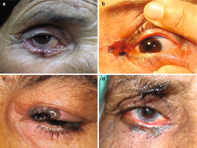 Benign Eyelid and Eye Growths > Fact Sheets > Yale Medicine