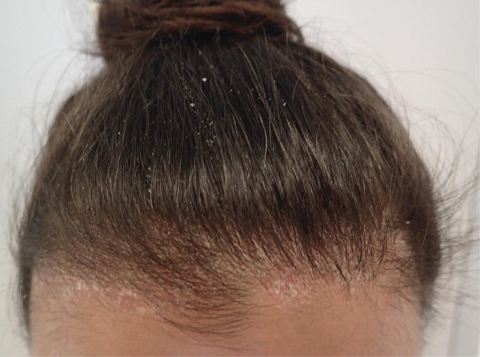 6 Pro Tips on How to Get Rid of Dry Scalp  Prose