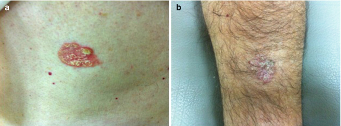 Non-melanoma Skin Cancer and Cutaneous Melanoma from Dermatological Point  of View
