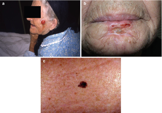 non melanotic malignant neoplasm of the skin Non-melanoma Skin Cancer and Cutaneous Melanoma from Radiotherapeutic Point  of View