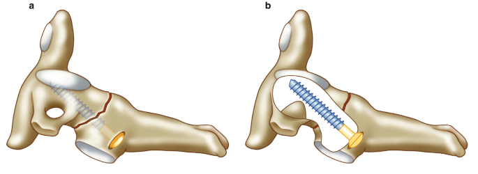 Hangman – Proximal