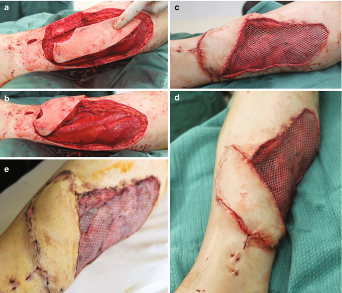Soft Tissue Reconstruction of the Lower Limb