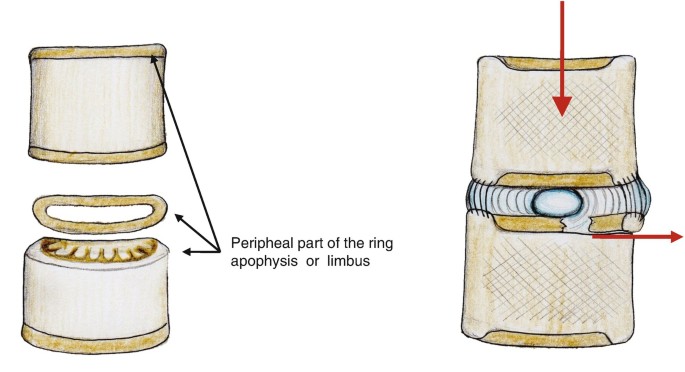 The Growth Cartilages of the Spine and Pelvic Vertebra | SpringerLink