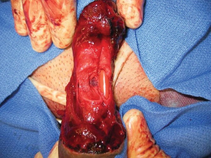 Penile Trauma or Fracture  Brandywine Urology Consultants
