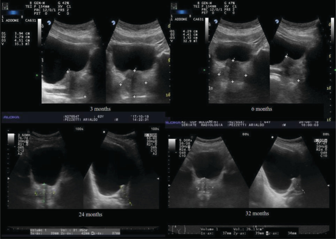 Benign Prostatic Hyperplasia and Prostate Cancer Laser Ablation |  SpringerLink