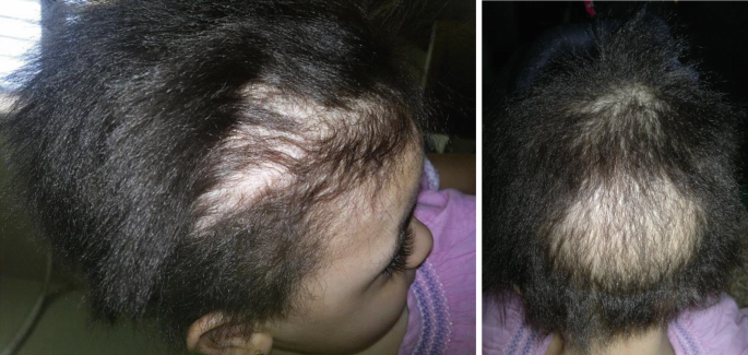 A Child with Frizzy Uncombable Hair | SpringerLink A Child with Frizzy Uncombable Hair | SpringerLink