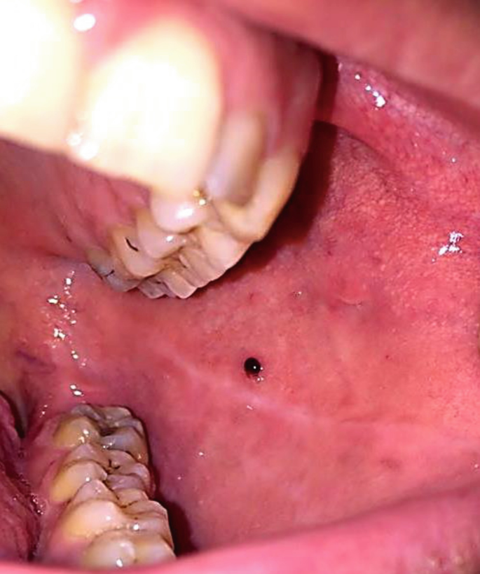 blood blister in mouth