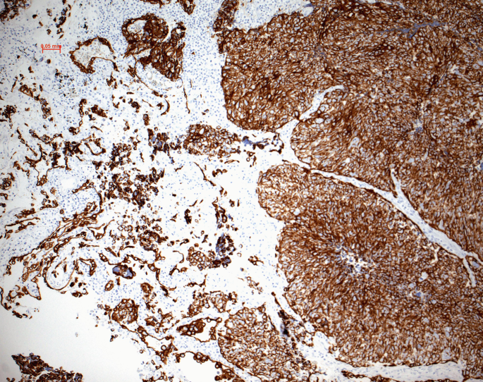 Large Cell Neuroendocrine Carcinoma | SpringerLink