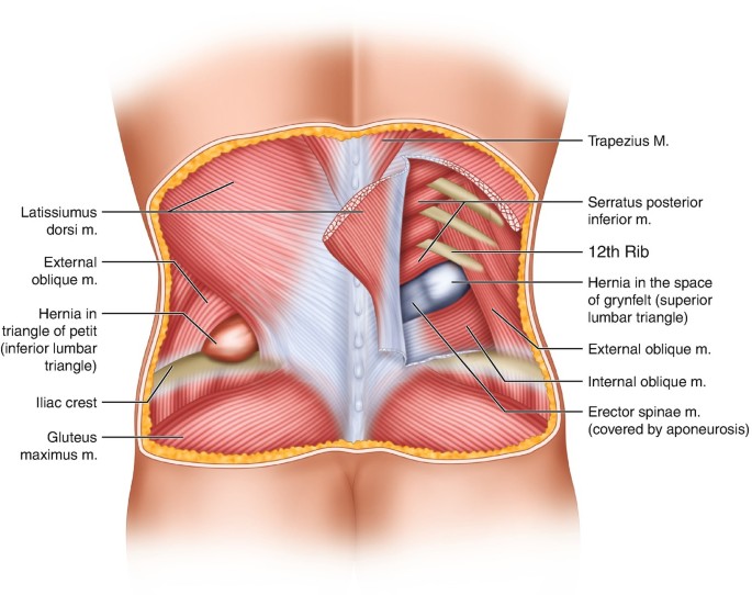 Lumbar Hernia | SpringerLink