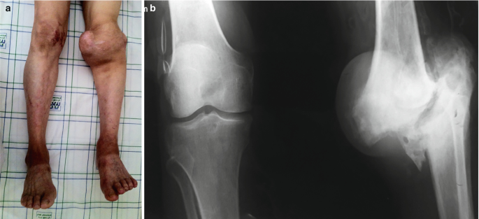 Syphilis-Related Musculoskeletal Manifestations | SpringerLink