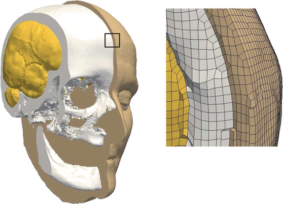 Medical Science Monitor  Biomechanical Behavior of All-on-4 and M-4  Configurations in an Atrophic Maxilla: A 3D Finite Element Method - Article  abstract #929908