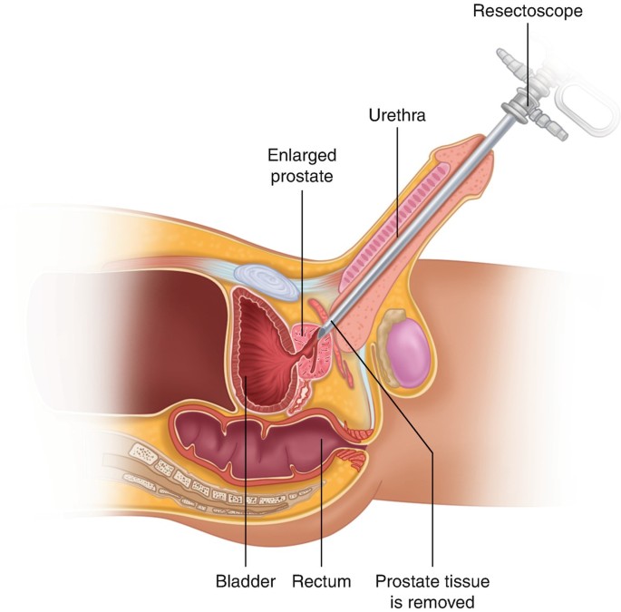 Indications for Surgical Management of Benign Prostatic Hyperplasia |  SpringerLink
