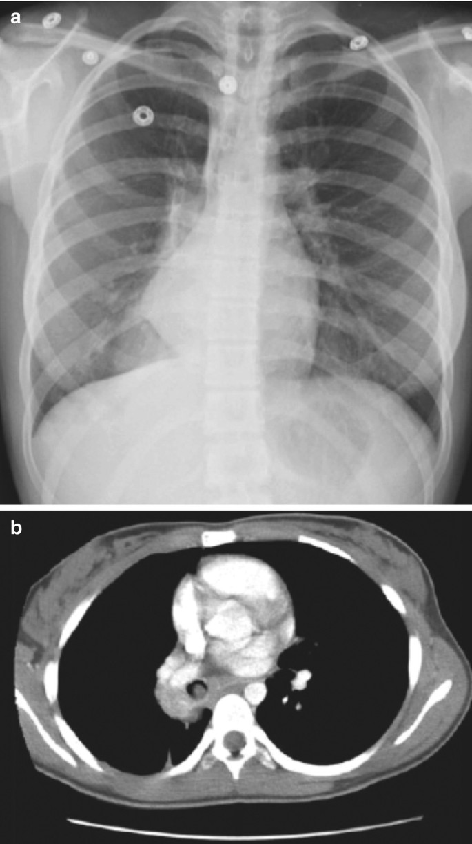 Chest X-ray Technique | Lungs