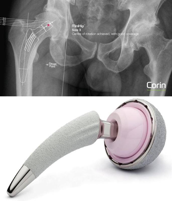 The Evolution of Total Hip Replacement