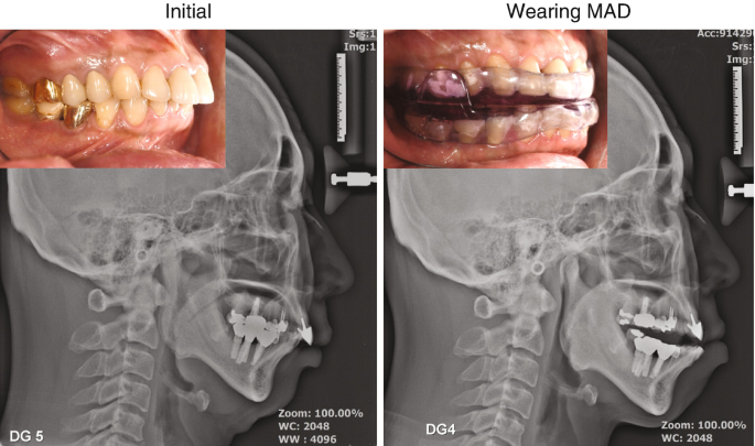 Two-piece mandibular advancement device without elastic retention band