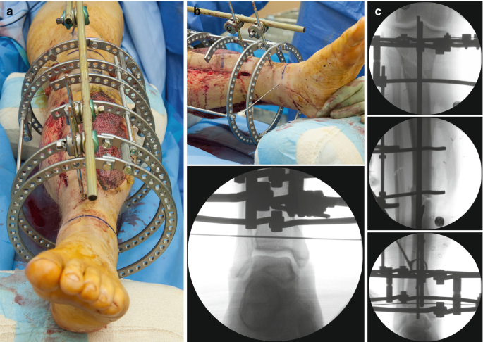 Full ring external fixation (Ilizarov) for Extraarticular, wedge fracture